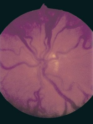 Infant Eye in the Pediatric Eye Care Study